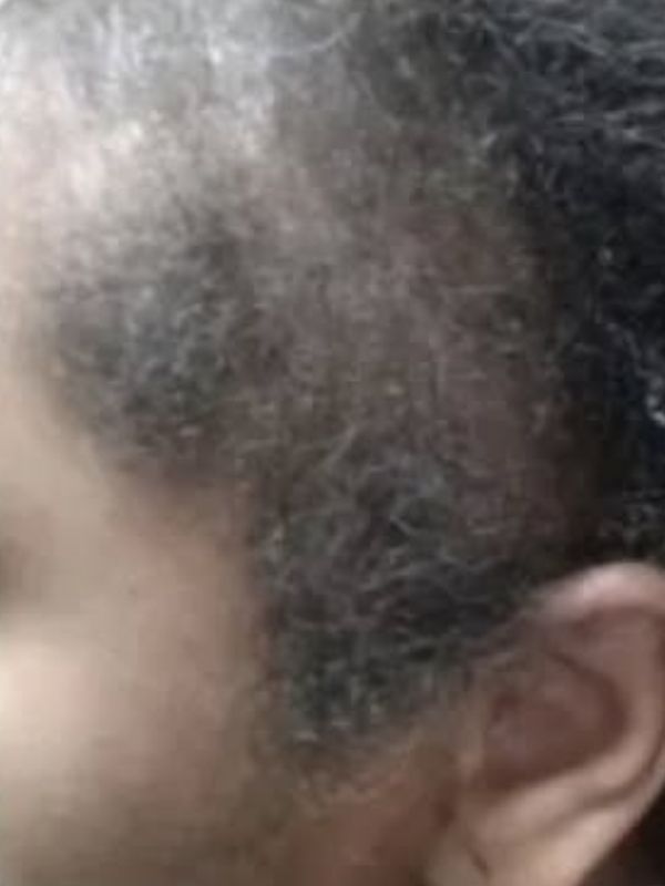After — Thinning hair treatment transformation